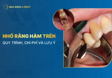 nhổ răng hàm trên