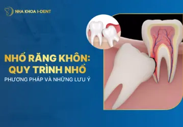 nhổ răng khôn