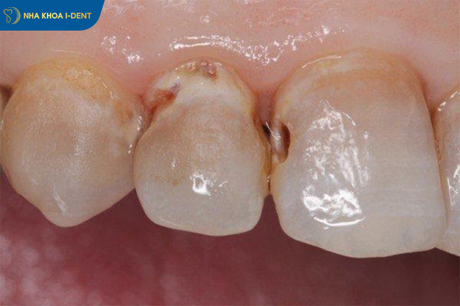 những tác hại của việc không nhổ răng sâu.