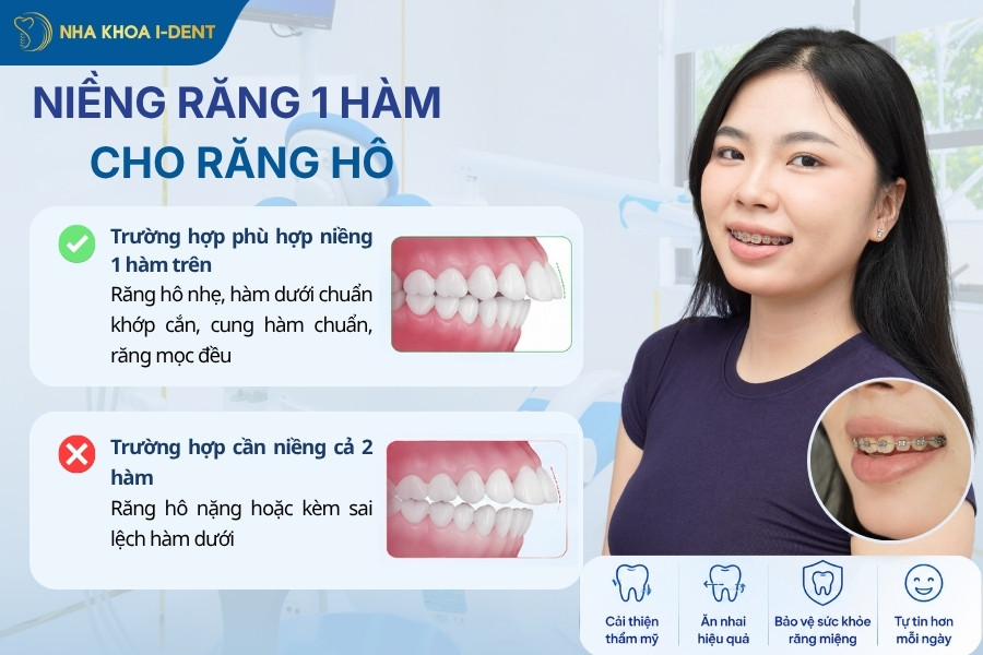 niềng răng 1 hàm trên có được không