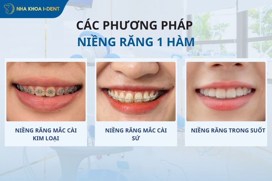 niềng răng một hàm có được hay không