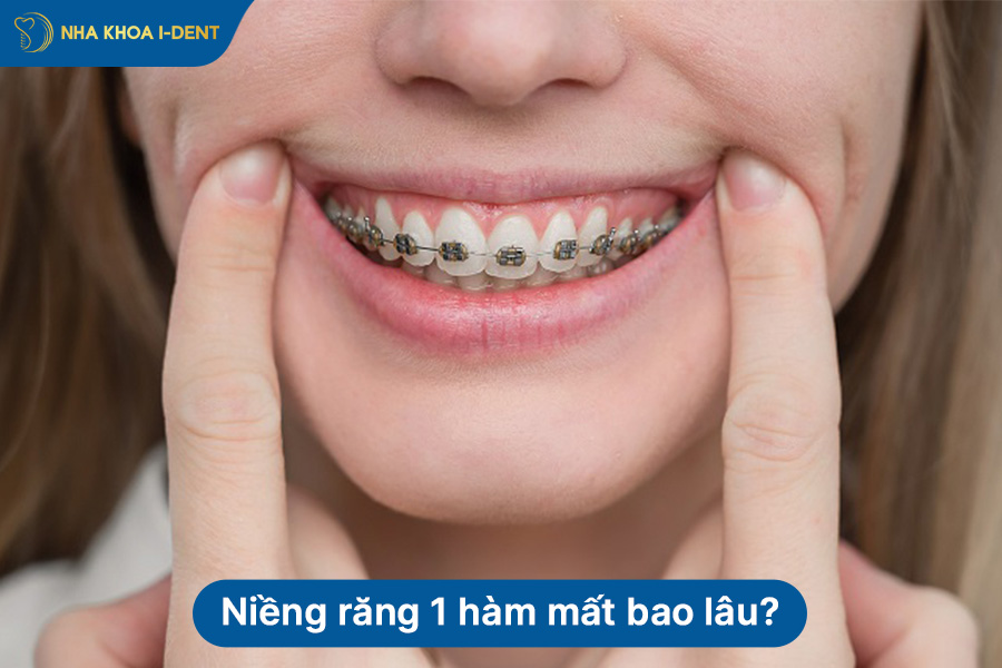 niềng răng 1 hàm có được không