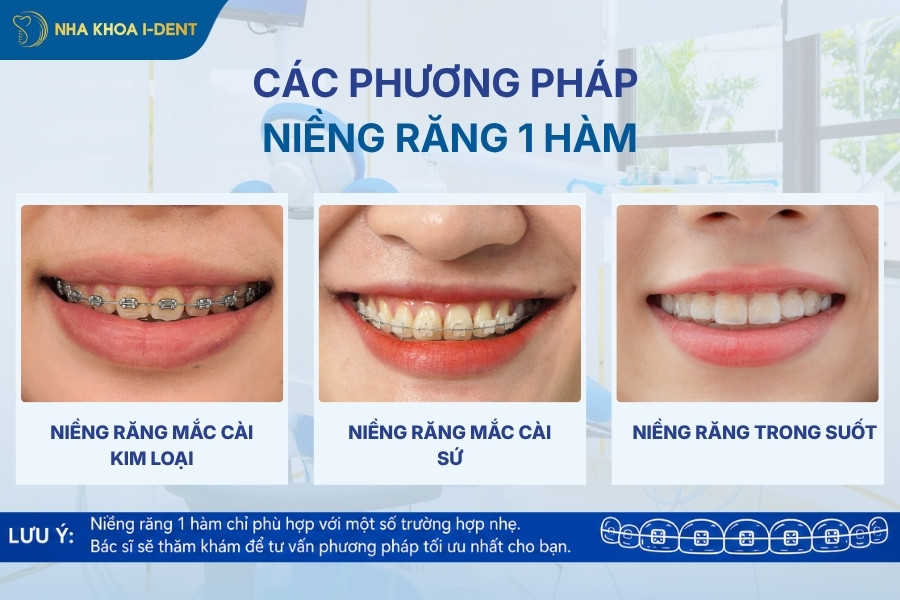 niềng răng 1 hàm được không