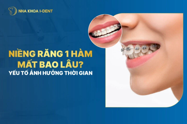 niềng răng 1 hàm mất bao lâu