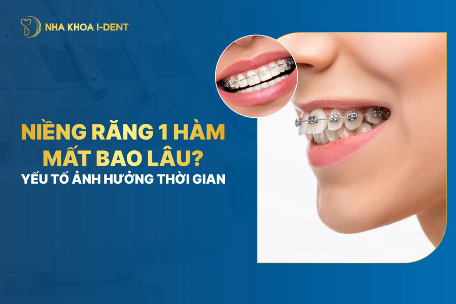 niềng răng 1 hàm mất bao lâu