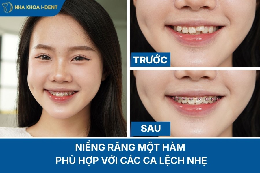 niềng răng 1 hàm có được không