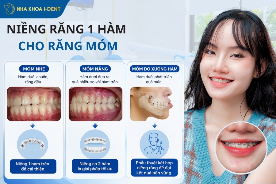 niềng răng một hàm có được không