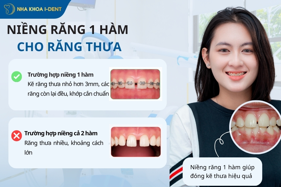 niềng răng một hàm