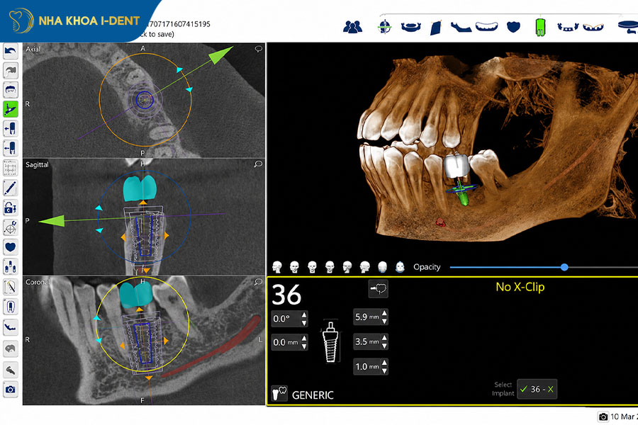 Robot implant x-guide xnt