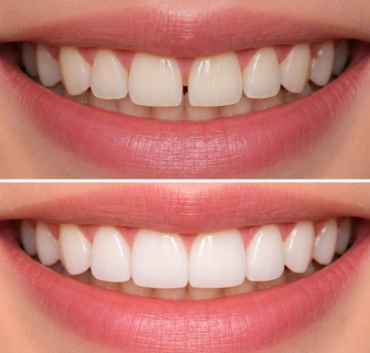 Khách hàng dán sứ veneer điều trị răng thưa tại I-Dent.