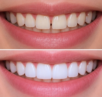 Khách hàng dán sứ veneer điều trị răng thưa tại I-Dent.