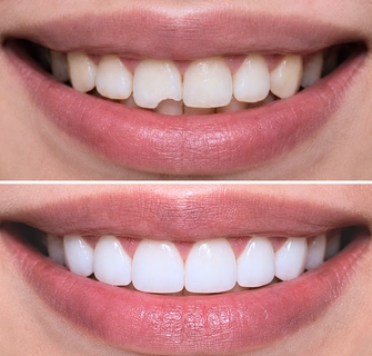 Khách hàng dán sứ veneer điều trị răng mẻ tại I-Dent.