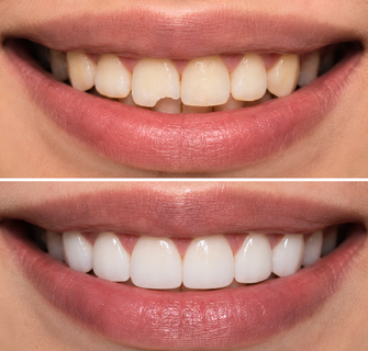 Khách hàng dán sứ veneer điều trị răng thưa tại I-Dent.