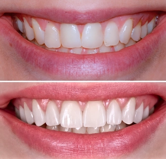 Khách hàng dán sứ veneer điều trị răng lệch lạc nhẹ tại I-Dent.