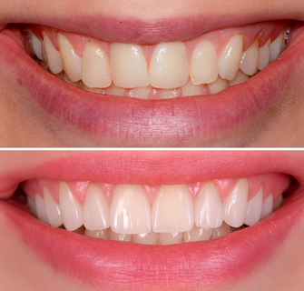 Khách hàng dán sứ veneer điều trị răng thưa tại I-Dent.