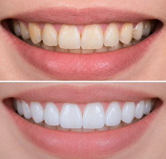 Khách hàng dán sứ veneer điều trị răng hô, móm nhẹ tại I-Dent.