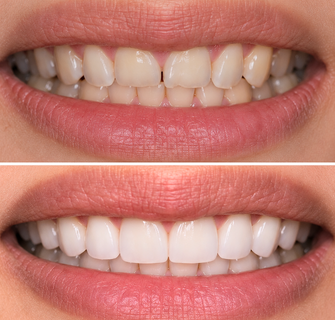 Khách hàng dán sứ veneer điều trị răng thưa tại I-Dent.