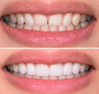 Khách hàng dán sứ veneer điều trị răng xỉn màu tại I-Dent.