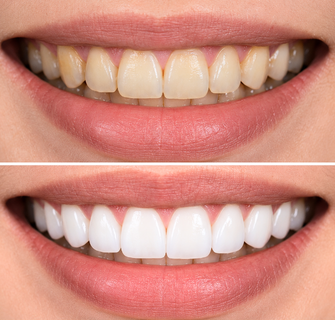 Khách hàng dán sứ veneer điều trị răng thưa tại I-Dent.