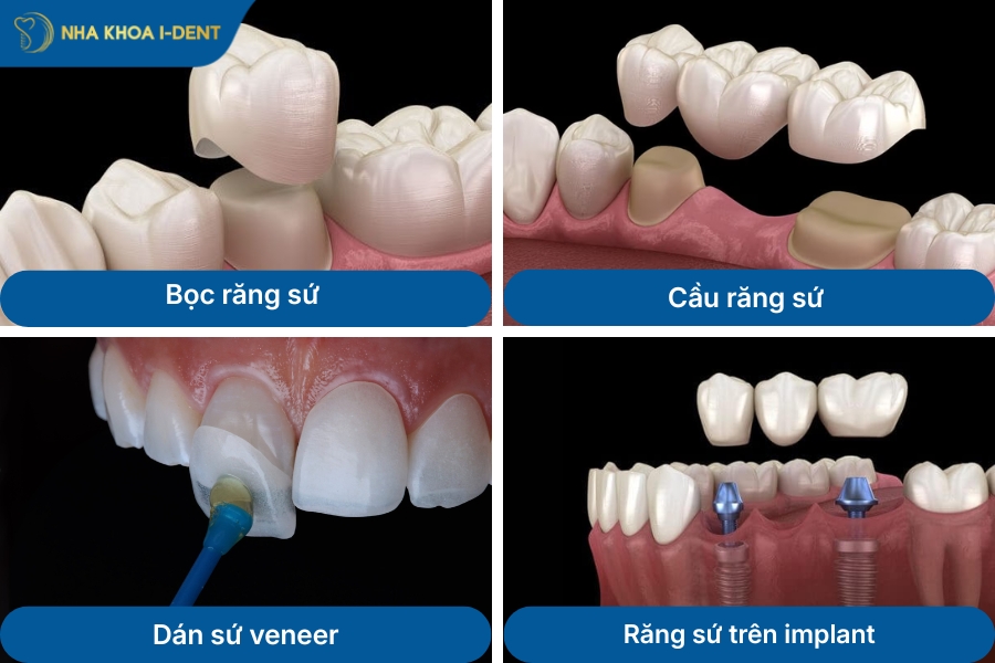 bọc răng sứ bao nhiêu