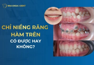 chỉ niềng răng hàm trên có được hay không
