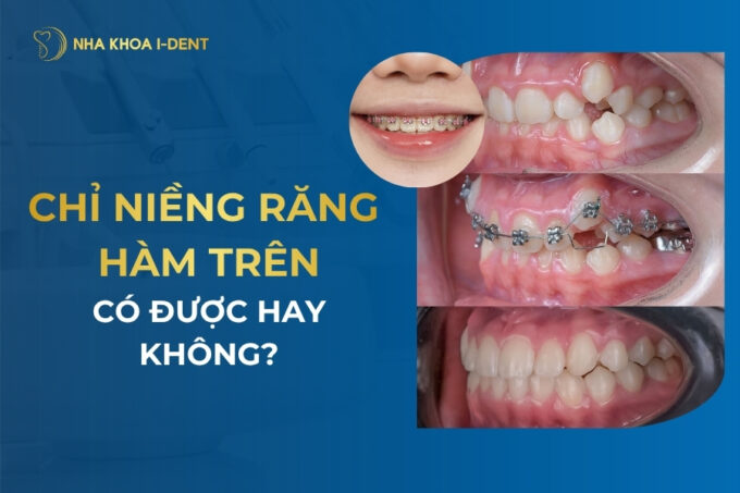 chỉ niềng răng hàm trên có được hay không
