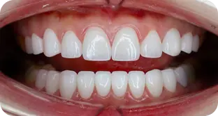 Dáng răng sứ cá tính