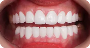 Dáng răng sứ dễ thương