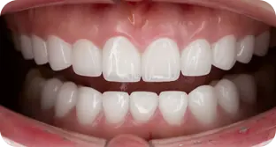 Dáng răng sứ tự nhiên