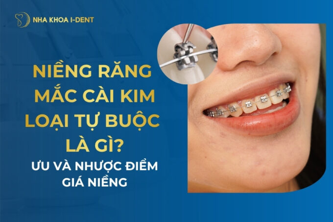 mắc cài kim loại tự buộc
