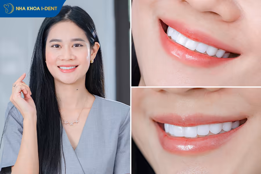khách hàng bọc răng sứ