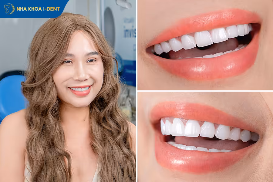 khách hàng bọc răng sứ