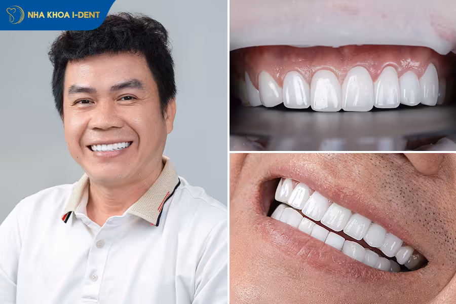 khách hàng bọc răng sứ