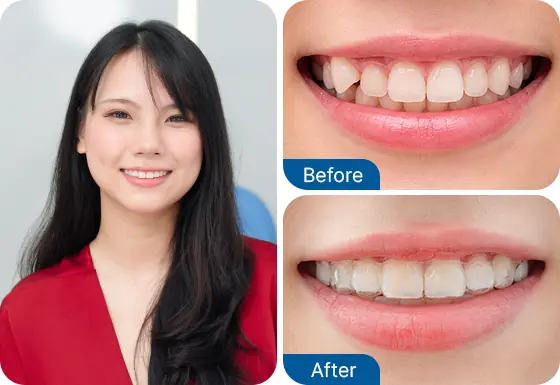 Kiều Oanh niềng răng Invislaign tại Nha khoa I-Dent