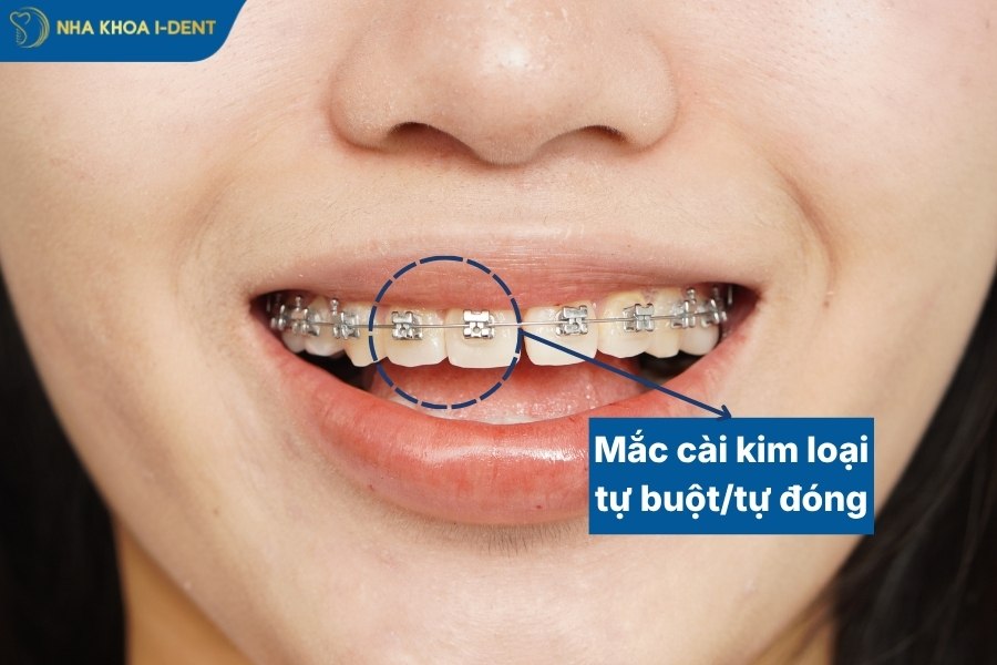 mắc cài kim loại tự buộc