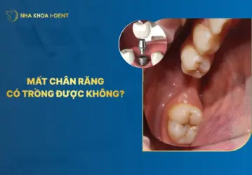 mất chân răng có trồng dược không