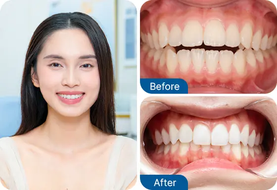 Nguyễn Mai Hân niềng răng Invislaign tại Nha khoa I-Dent