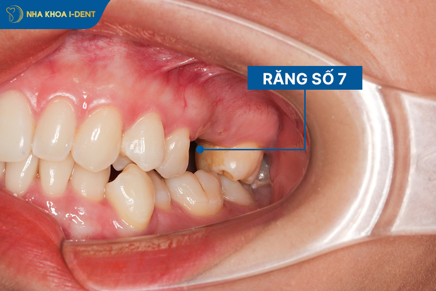 nhổ răng số 7 có cần trồng lại không