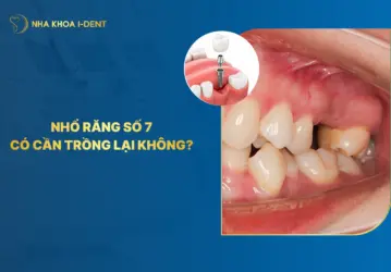 nhổ răng số 7 có cần trồng lại