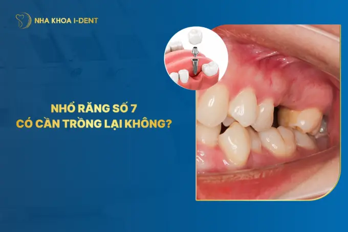 nhổ răng số 7 có cần trồng lại