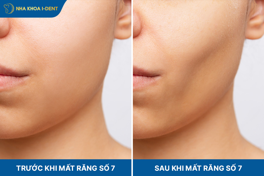 nhổ răng số 7 nên trồng lại không