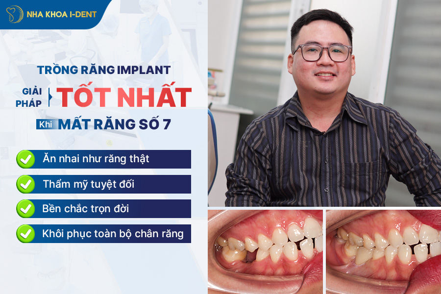 nhổ răng số 7 rồi có cần trồng lại không