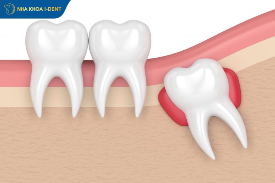 nhổ răng số 8 có ảnh hưởng gì không
