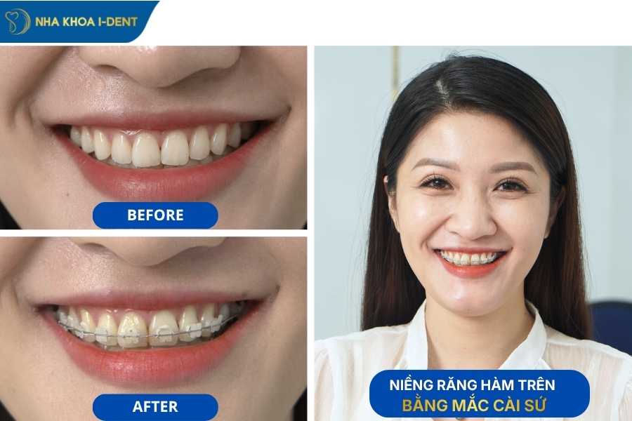 niềng răng hàm trên có được không