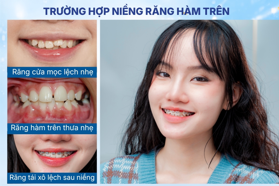 niềng hàm trên