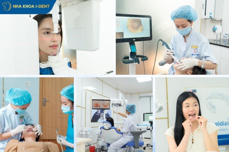 niềng mắc cài kim loại tự buộc