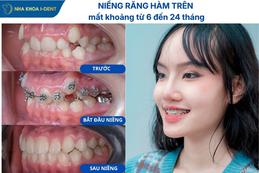 niềng răng hàm trên có được không