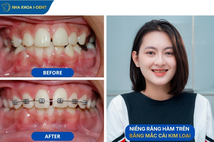 niềng răng hàm trên được không
