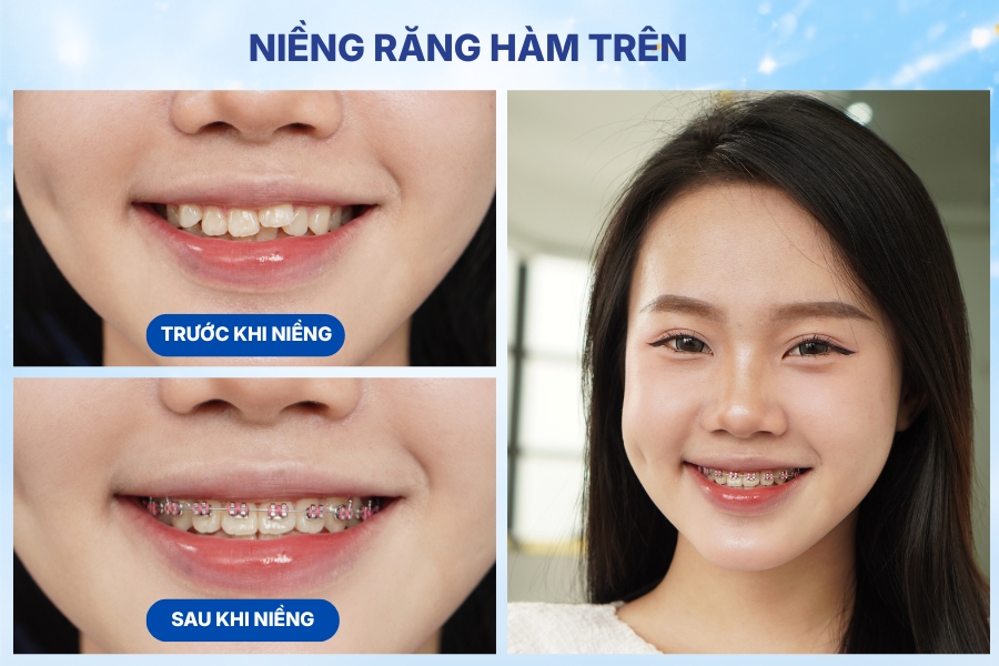 niềng răng 1 hàm trên