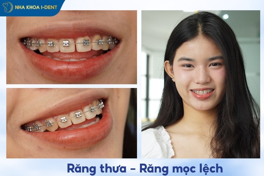 niềng răng mắc cài kim loại tự buộc là gì